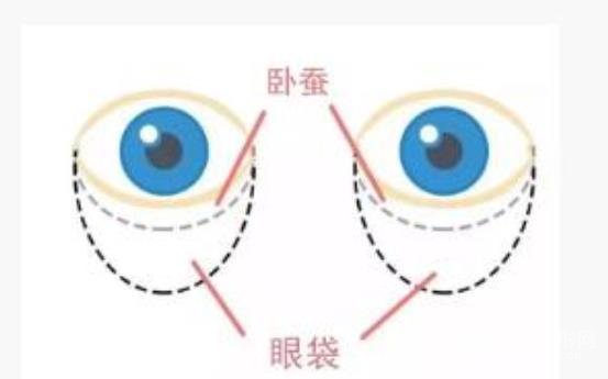 祛眼袋手術果可以維持多久?