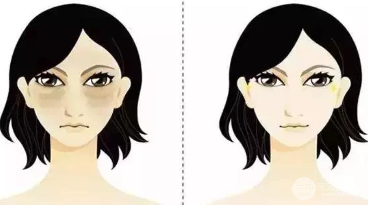 祛眼袋手術會反彈嗎