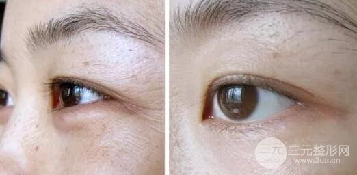 眼部熱瑪吉術(shù)后