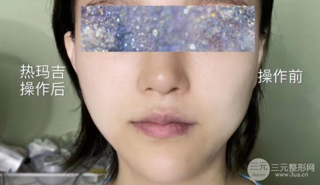 熱瑪吉緊膚除皺果圖