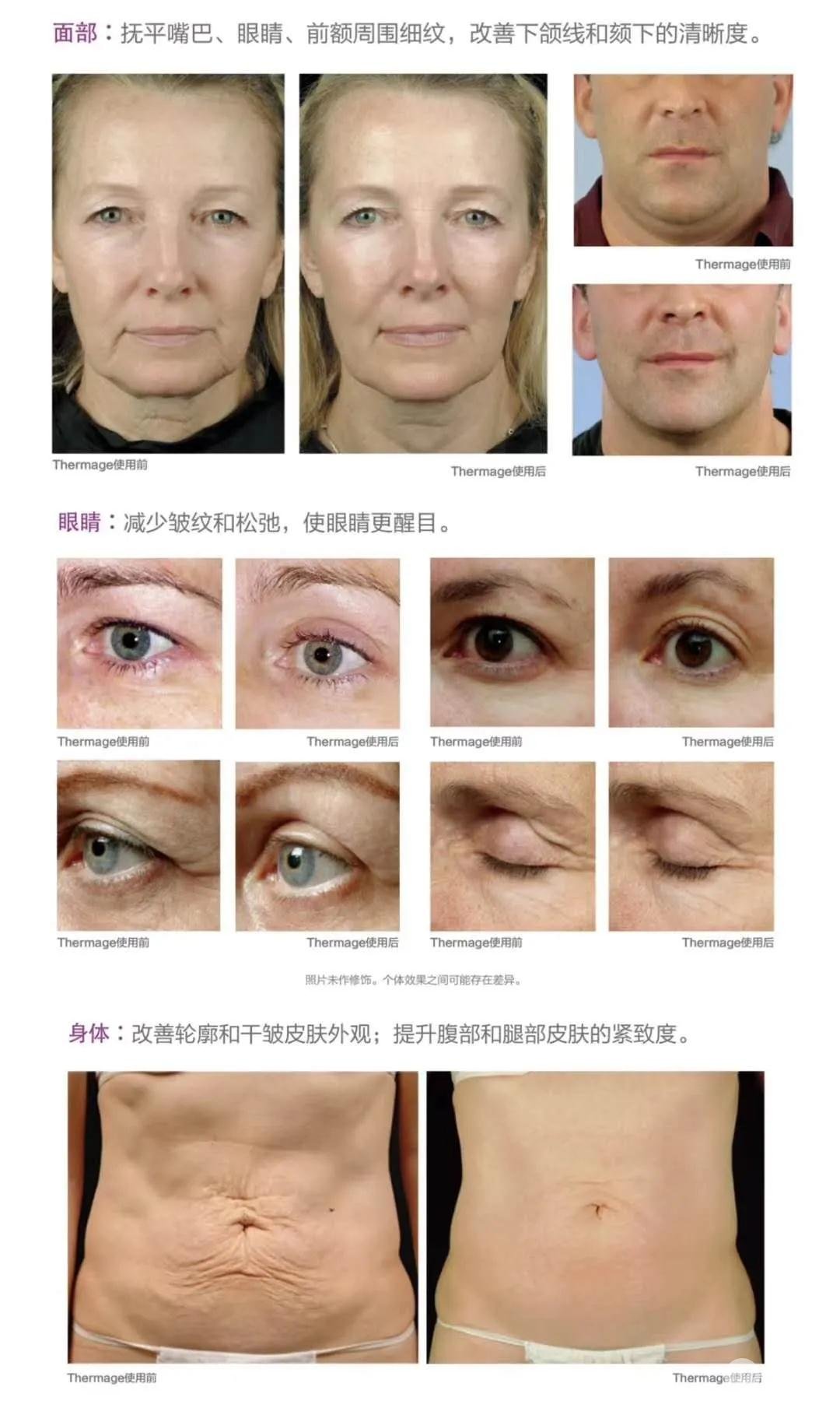 熱瑪注射瘦臉用范圍