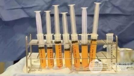 脂肪填充臉部的副作用有哪些?