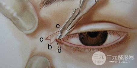 割雙眼皮開眼角需要多少錢