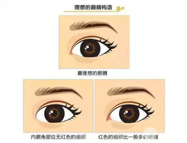割雙眼皮開眼角手術注意事項
