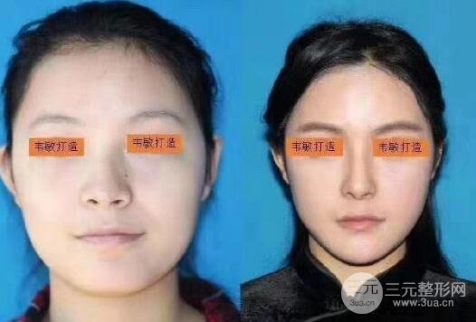 做改臉型術(shù)果好不好