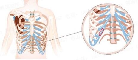 肋軟骨隆鼻的優(yōu)點