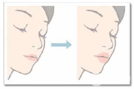 注射玻尿酸豐唇需要幾支