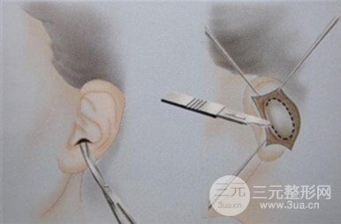 自體耳軟骨隆鼻危害有哪些?