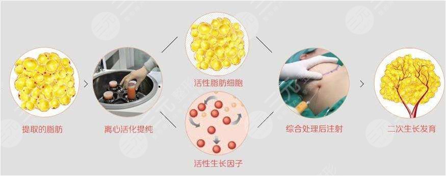 脂肪移植隆胸降低風(fēng)險(xiǎn)嗎?