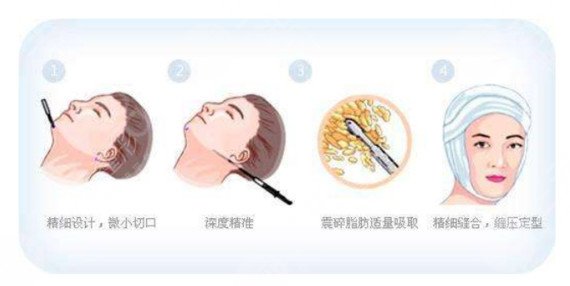 面部光纖溶脂后需要注意什么