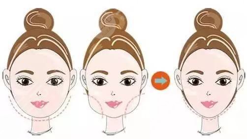 面部光纖溶脂多少錢