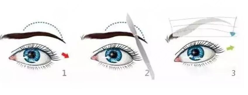 切眉術(shù)后的護(hù)理注意事項(xiàng)