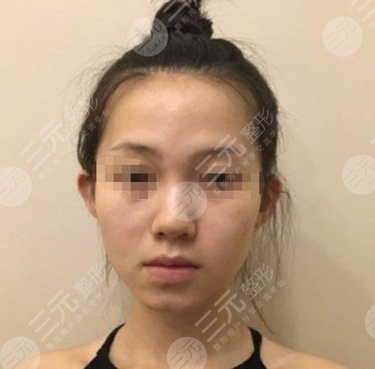 武漢中南醫(yī)院整形科隆鼻整形案例