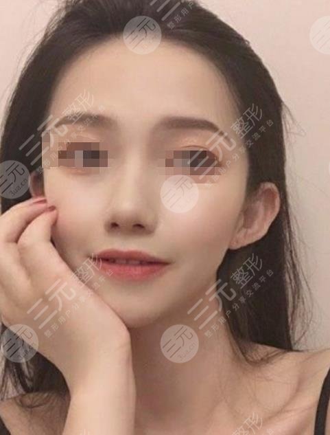 武漢中南醫(yī)院整形科隆鼻整形案例