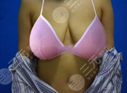 巨乳縮小術(shù)案例