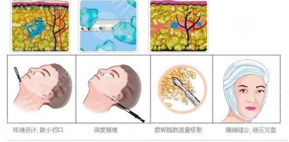 光纖溶脂瘦臉術(shù)后護(hù)理