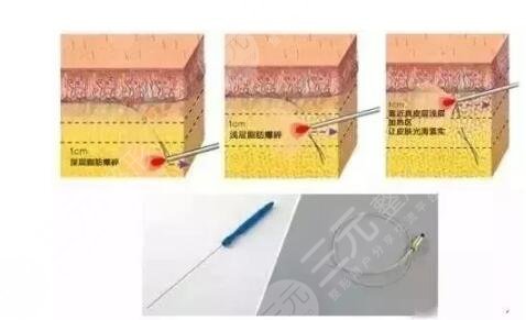 光纖溶脂瘦臉是*的嗎?
