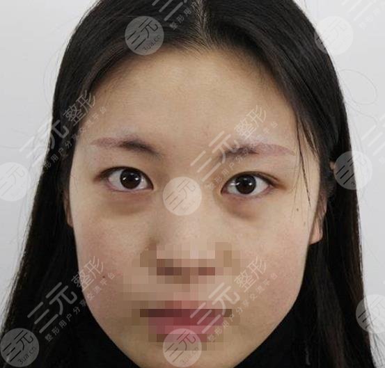 哈醫(yī)大一院整形美容中心激光去眼袋