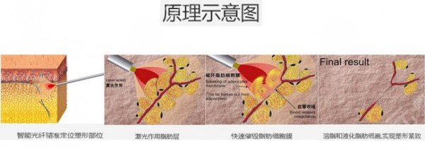 光纖溶脂瘦臉的優(yōu)勢(shì)