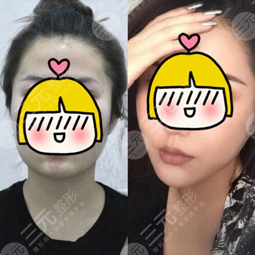 火鳳凰微創(chuàng)溶脂果圖