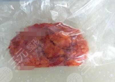 手術(shù)實(shí)際操作