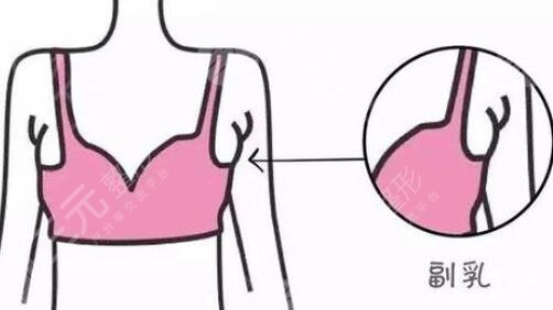 副乳切除手術(shù)注意事項(xiàng)