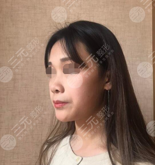 八大處周栩做鼻子隆鼻案例前