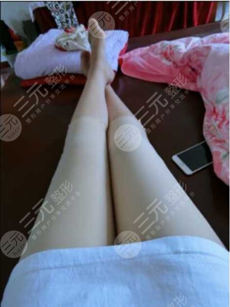 煙臺(tái)山醫(yī)院張文安吸脂后3個(gè)月