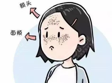 激光祛黃褐斑反多久可以恢復