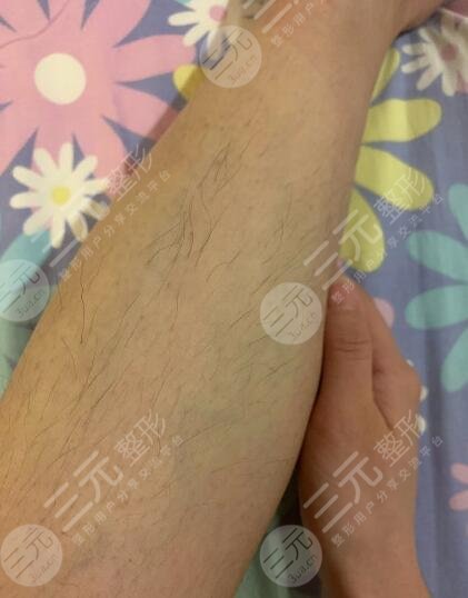 泰州市人民醫(yī)院脫毛價(jià)格貴嗎？如果你有嚴(yán)重汗毛煩惱一定不要錯(cuò)過！