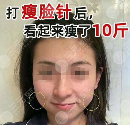 打注射瘦臉術(shù)后的注意事項(xiàng)