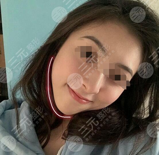 打注射瘦臉術(shù)后果