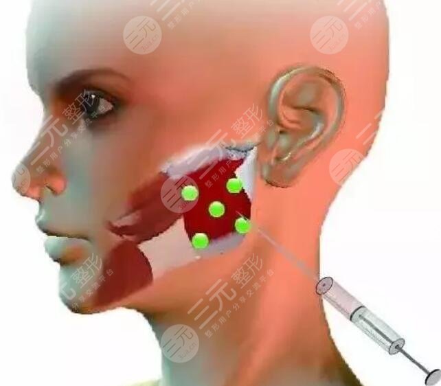 注射瘦臉的價格