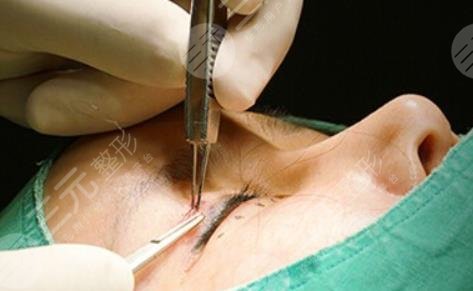 什么是韓式微創(chuàng)雙眼皮