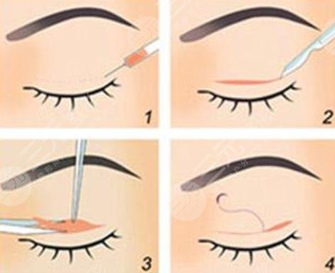 韓式微創(chuàng)雙眼皮可以保持多少年