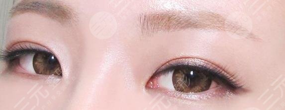 韓式微創(chuàng)雙眼皮的優(yōu)勢有哪些