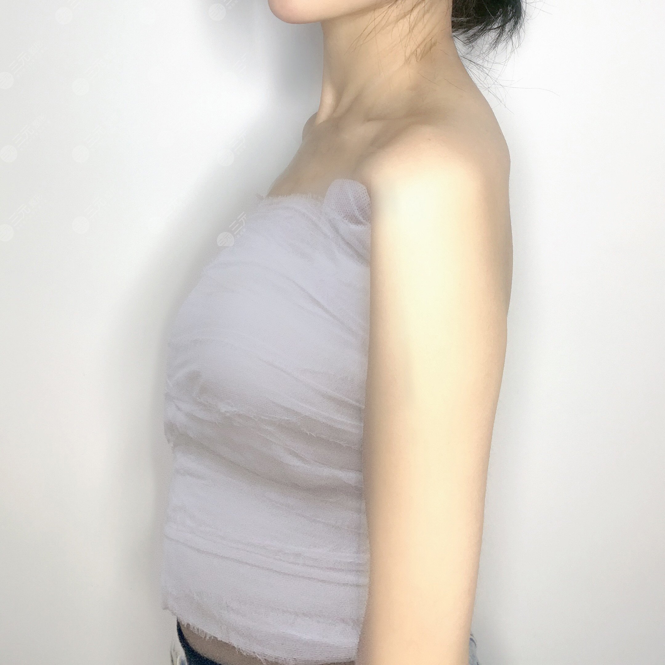 乳房縮小術(shù)前后對比,看了你就相信杭州美來比較好!