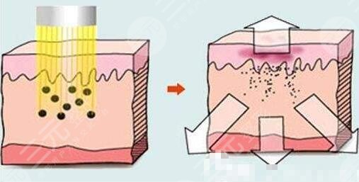 激光祛斑原理