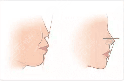 齙牙怎么矯正？如何解決齙牙這個(gè)問(wèn)題，成為了他們的重中之重