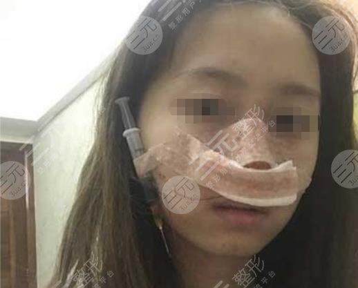 關(guān)于上海九院隆鼻手術(shù)