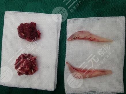 手術中損傷神經(jīng)