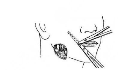 如何讓咬肌變??？