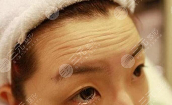 去抬頭紋大概要多少錢？深知4個(gè)原因影響了手術(shù)的價(jià)格！