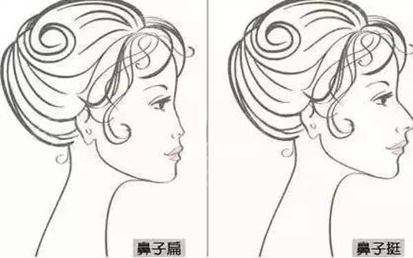 鼻翼縮小修復(fù)