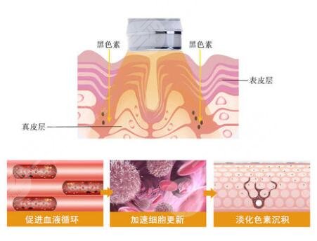 光子嫩膚原理是什么
