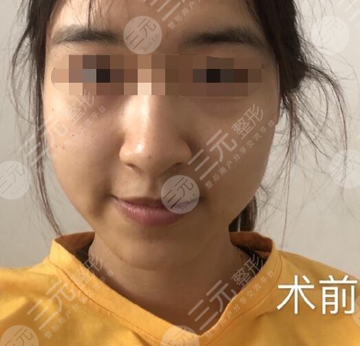 光子嫩膚一般多少錢一次呢