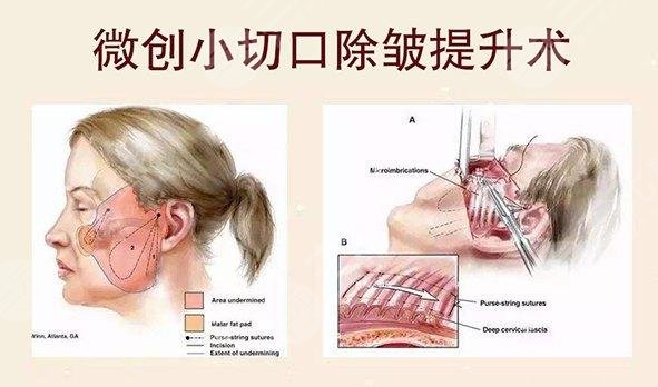 怎么去除額頭皺紋