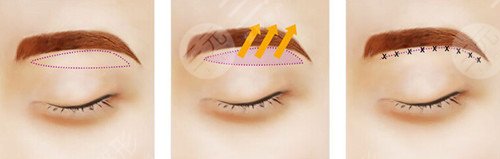 提眉術(shù)價(jià)格一般是多少