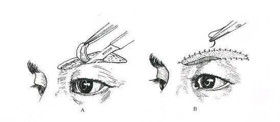 提眉術(shù)價(jià)格一般是多少