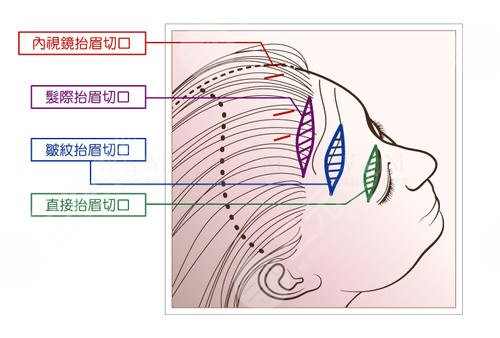 提眉術(shù)價(jià)格一般是多少